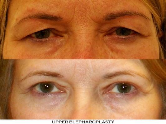 Upper Blepharoplasty performed on Both Eyes