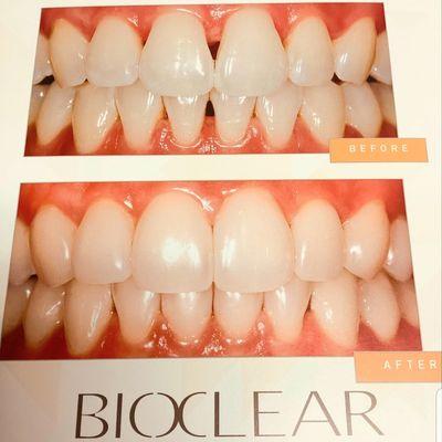 Dr. JoElla treats dark triangles with BIOCLEAR which is a less invasive procedure than crowns or veneers.