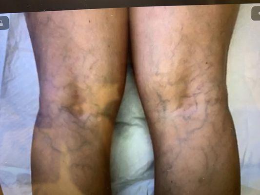 My legs before treatment (sclerotherapy)