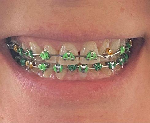 Fastbraces* St Patrick's day style!