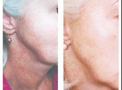 Before & After Photo of Photorejuvenation (Sun Spots)