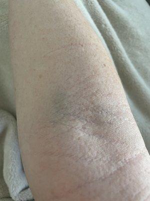 Bruising in the light and now 2 days post blood work. You can still see injection site. Embarrassing.