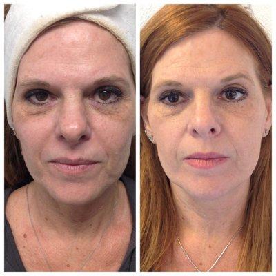 Results after just ONE Perfect Peel!!! Client saw an overall decrease in pigmentation and fine lines and is very pleased!