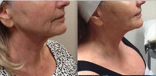 Virtue RF-Face & Neck, after 2nd treatment, before the 3rd.  Series of 3 txts, then 1 a year to maintain.