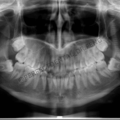 Wisdom teeth extraction