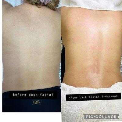 Back facial treatment