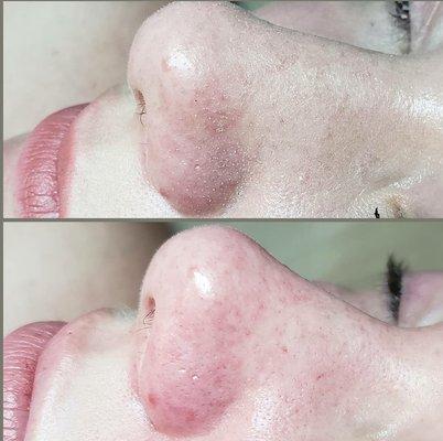 Removal of dead skin and clogged pores