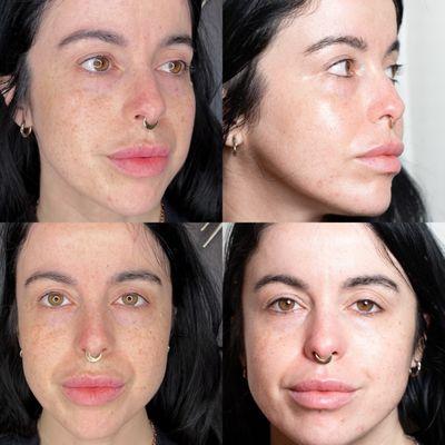 Full face fibroblast before and after