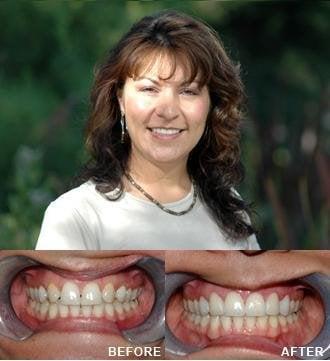 4 veneers