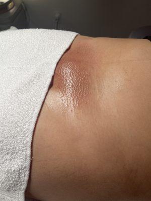 Brazilian sugaring