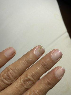 Nail infection from unsanitary dip powder