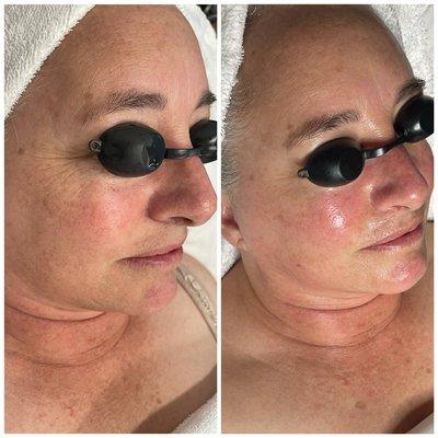 After 3 Age Gracefully sessions that rage from glow peels to Collagen Induction Therapy