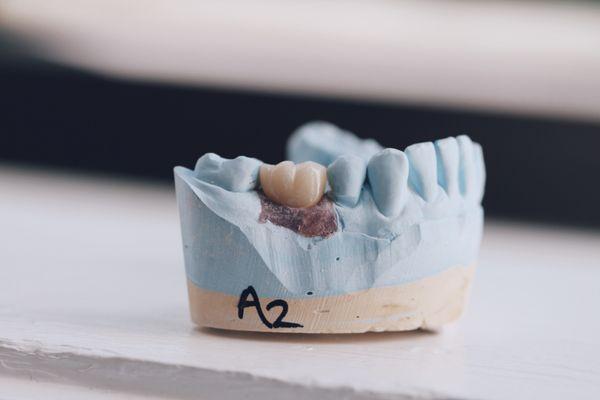 All porcelain implant crown