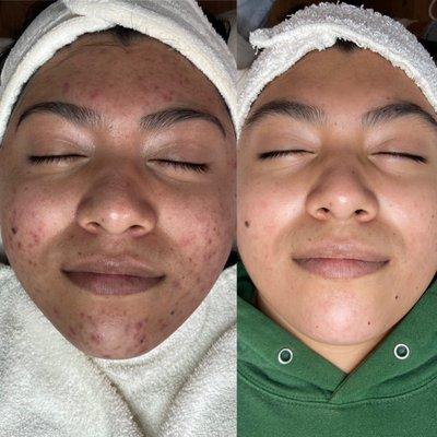 Before and After Acne Program