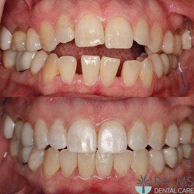 Completed by: Dr.Coakley! INVISALIGN