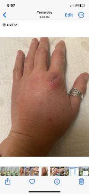 Hand wound infection. Painful,swollen, puss. Nothing done or told how to care for. No discharge paperwork.Left Same as came in