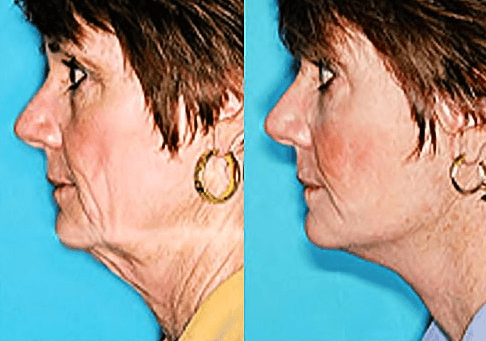 Scottsdale Facelift Surgery - Before & After. Read about the surgery: http://www.drdavidhecht.com/cosmetic-surgery/rhytidectomy-facelift/