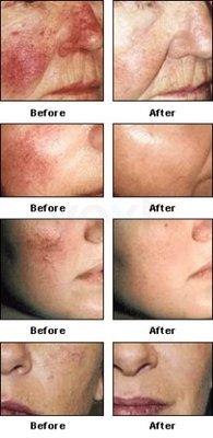 Facial Telangiectasia/Rosacea treatment with PDL Vbeam Laser