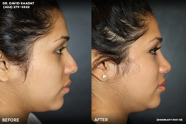 Rhinoplasty Surgery Side View | Beverly Hills
 drdavidsaadat.com | 310-247-9090