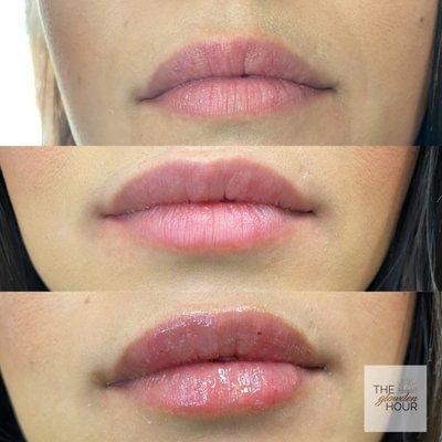 Hyaluronic Acid Lip Infusions