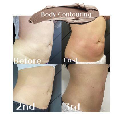 Abdomen: skin tightening and body contouring