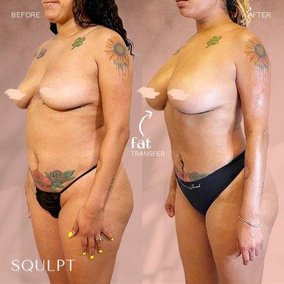 Fat Transfer to Breasts (875 cc/right, 775 cc/left) + SoftSqulpt™ awake lipo to abdomen, waist & hips, lower back, back bra roll