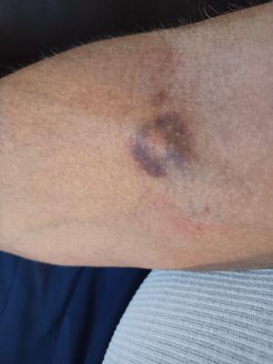 Bruise from phlebotomist   pushing needle through the vein 2 days ago