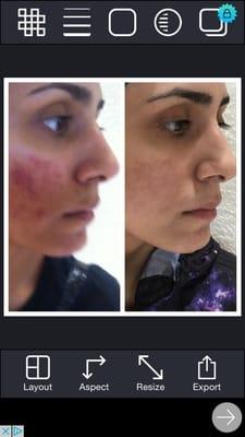 Manasra client before and after Acne treatment