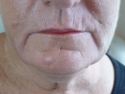 Actual Patient of Dr Olga Zilberstein, lips, marionette lines before