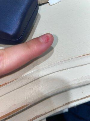 The attempt to remove the nail without soaking