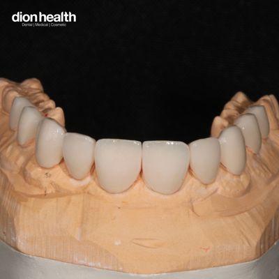 porcelain veneers