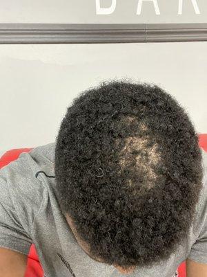 Bald spot from the barber, my hair was perfectly leveled.