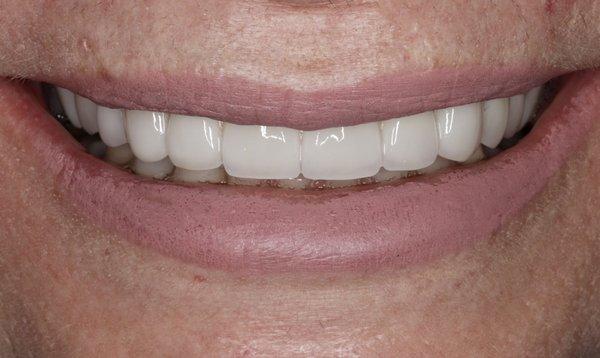 Beautiful porcelain veneers done by Dr.Ha