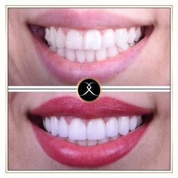 Smile Makeover