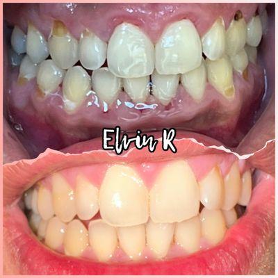 Gum disease, acid erosion from what dr ochev explained to me and cavities.   MY BEFORE AND AFTER