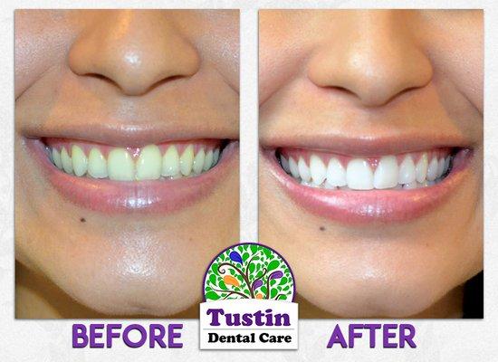 Kristy's Zoom whitening transformation!