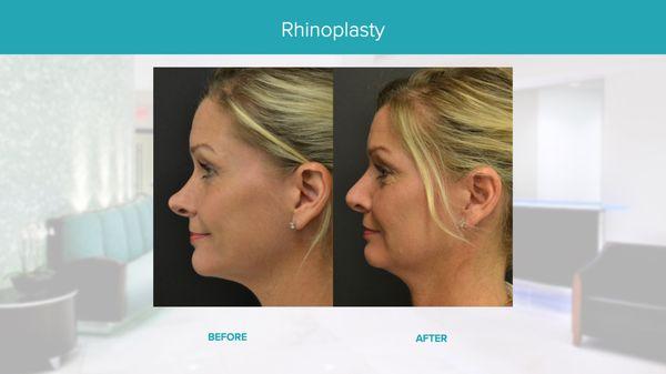 Real Results Before & After-Rhinoplasty