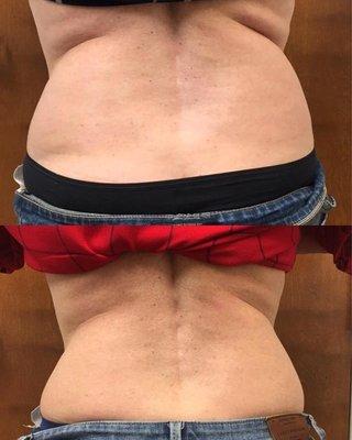 truSculpt 3D Treatment - 12 Weeks Post-Treatment