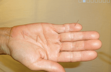 Koryo hand acupuncture performed by Dr.Chung