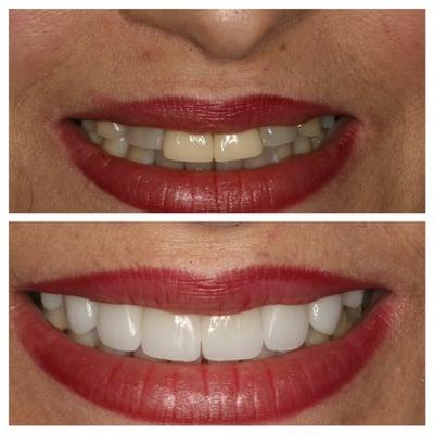 Not all crowns are created equal. Replacing 2 old crowns in the front and doing an additional four made a huge difference!