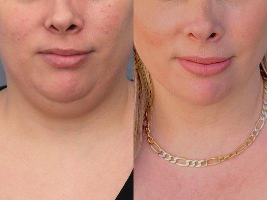 Neck micro-liposuction.