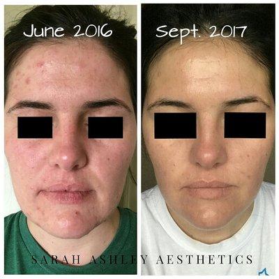 Long distance acne client. Making great progress in just 3 months!