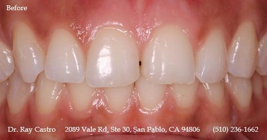 (before) Our patient was always unhappy with the gap and the chipping on her two front teeth. This is an actual patient of Dr. Castro.