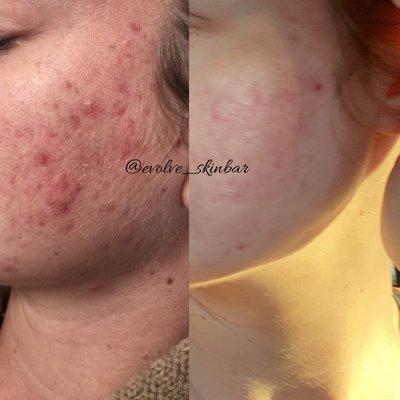 Another example of clients with acne. Few services later and her skin is already clearing . Next up acne scars