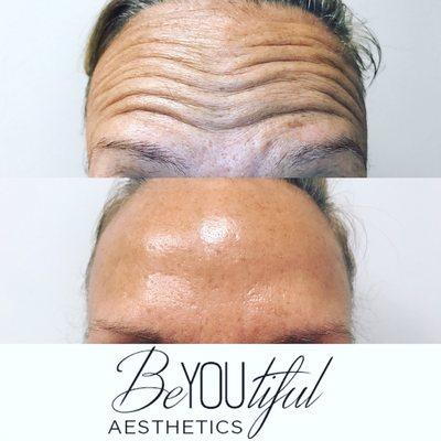 What wrinkles?? We love Botox!!