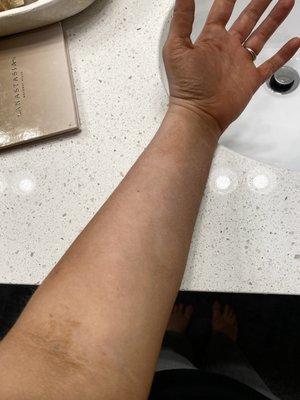 Uneven in the bend of the arm