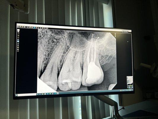 Root canal after photo, amazing! No pain!