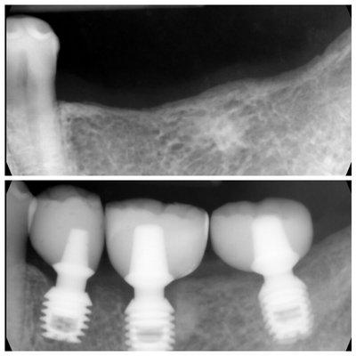 The idea of implants teeth, Dr Thanh-Duc Nguyen 2011