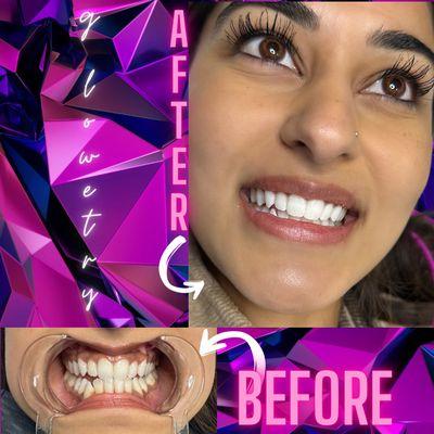 Teeth Whitening by Glowetry