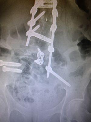 Failed lumbar fusion